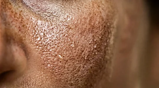 Trattamento di biorivitalizzazione su pelle del viso con idratazione profonda senza volume